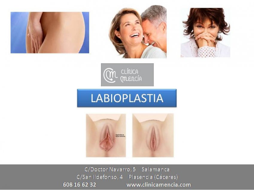 LABIOPLASTIA